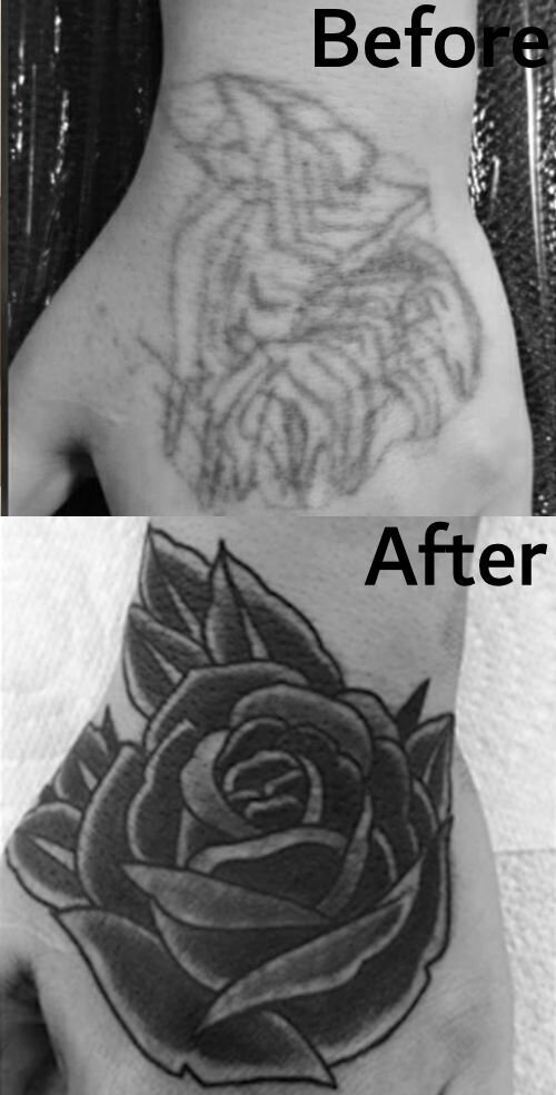 rose on hand removal,Dublin tattoo removal, laser tattoo removal